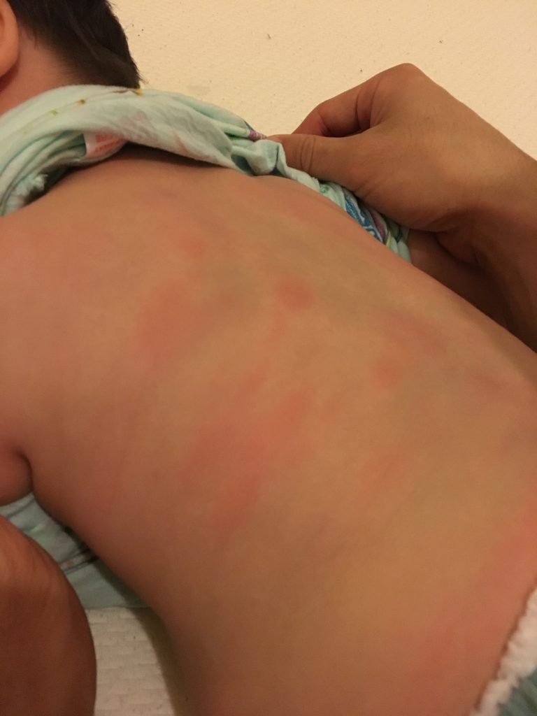 一塊一塊的很癢，抓了還會流血😭