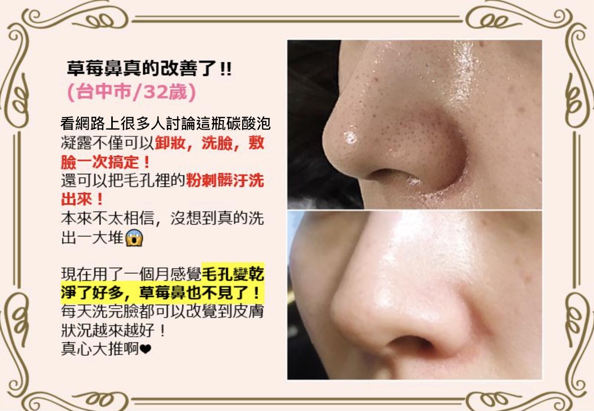 日本 藥妝 推薦 肌純 碳酸泡泡 碳酸面膜 粉刺神器 黑頭 毛孔 痘痘肌 保濕 溫和 深清毛孔 拔粉刺
