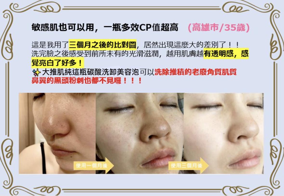 日本 藥妝 推薦 肌純 碳酸泡泡 碳酸面膜 粉刺神器 黑頭 毛孔 痘痘肌 保濕 溫和 深清毛孔 拔粉刺